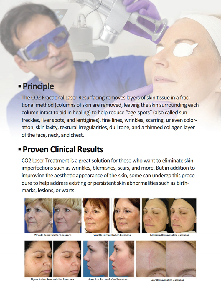 HOT Dermatology Aesthetic vaginal tigthening fractional co2 laser equipment