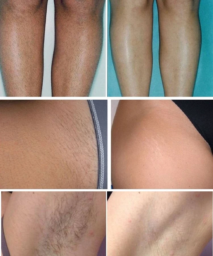 Before&After of Hair Removal