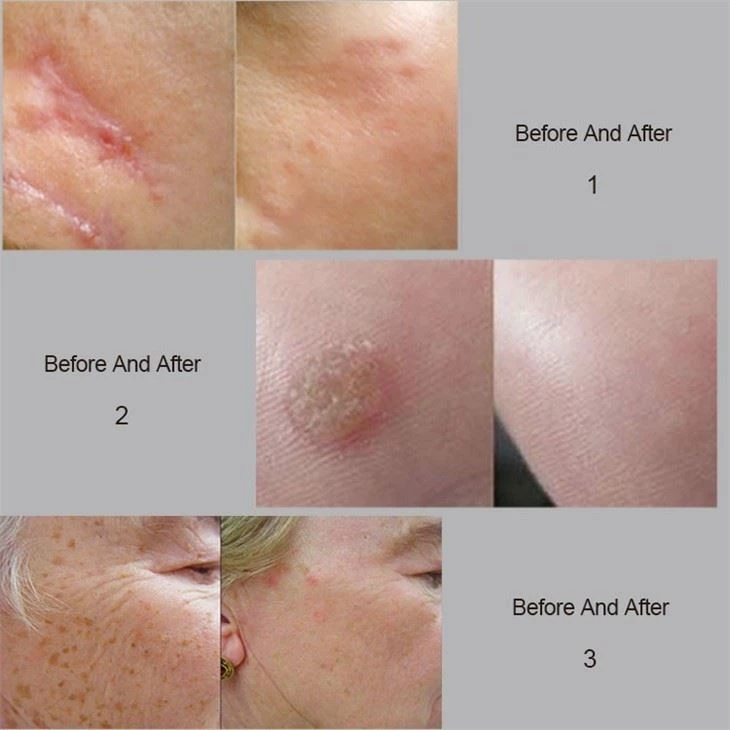CO2 Fractional Laser Spically For Scar Removal